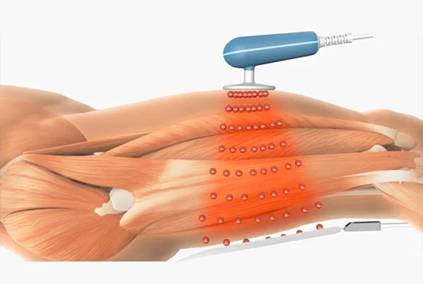 CRET Therapy
