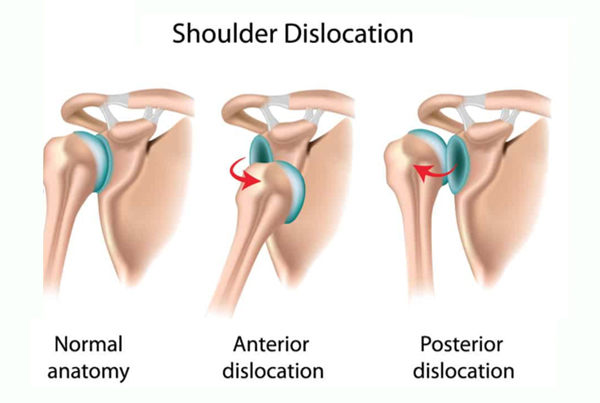 Shoulder Dislocation or Instability