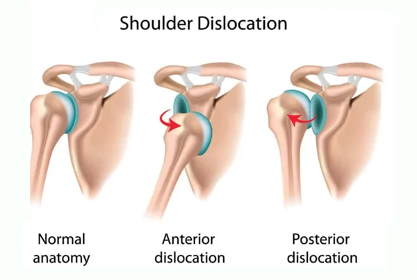 Shoulder Dislocation or Instability