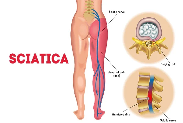Sciatica and Radiating Pain