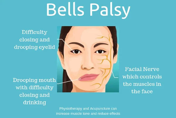 Bells Palsy
