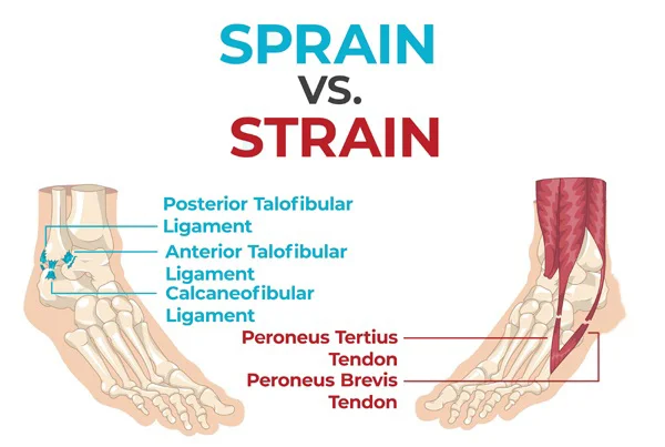 Sprain and Strain