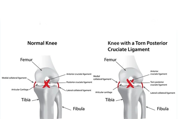 Posterior Cruciate Ligament