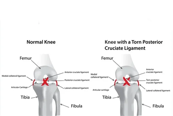 Posterior Cruciate Ligament