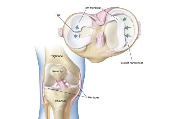 Meniscus Injury