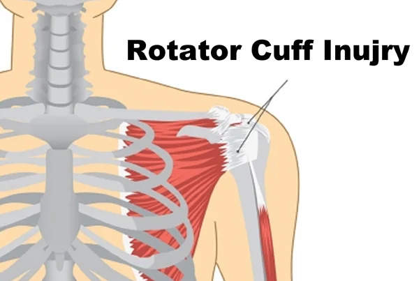 Rotator Cuff Injury