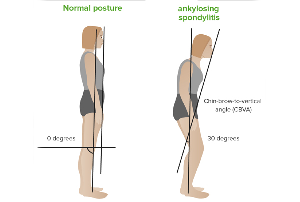 Ankylosing Spondylitis