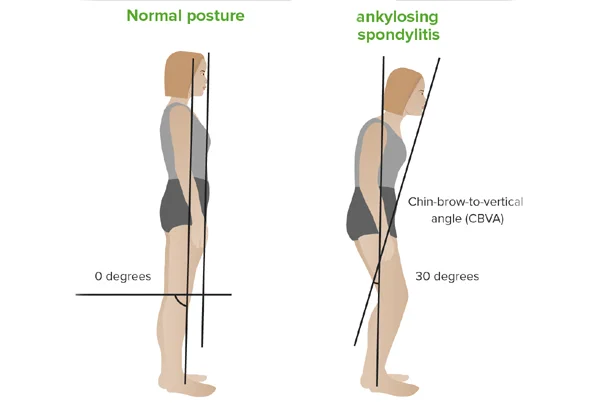 Ankylosing Spondylitis