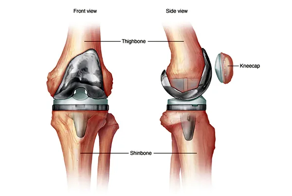 Total Knee Replacementt