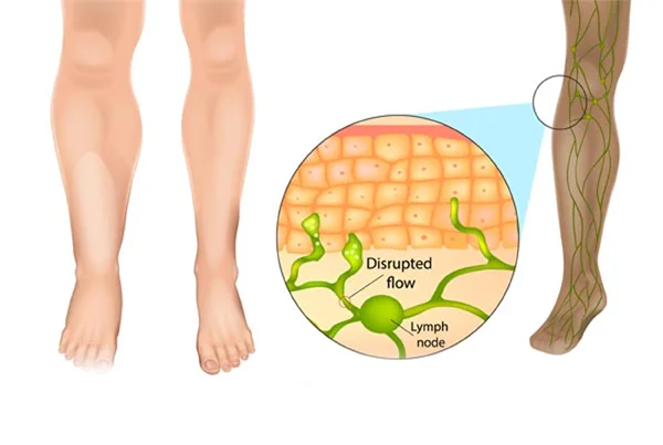 Lymphedema