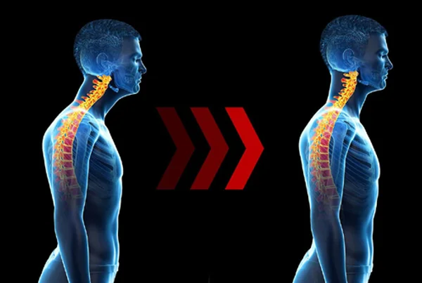 Forward Head Posture Syndrome