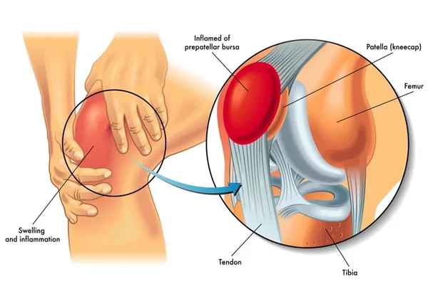 Bursitis  Tendonitis