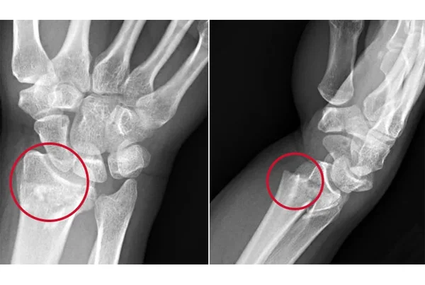 Colles Fracture