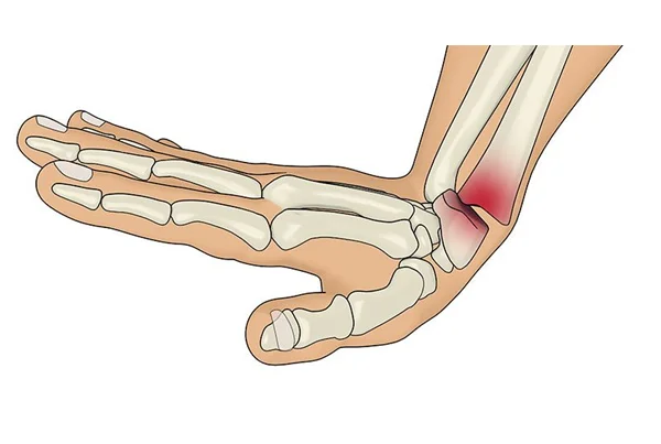 Smiths Fracture