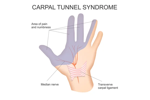 Carpal Tunnel Syndrome