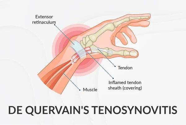 De  Quervain Tenosynovitis