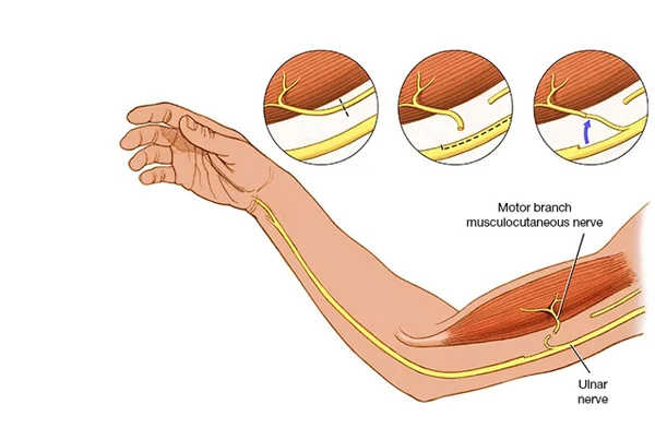 Nerve Injuries