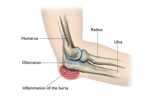 Olecranon Bursitis