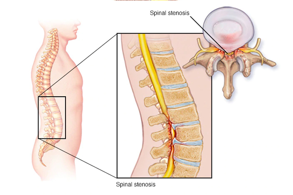 Spinal Stenosis