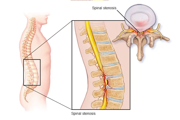 Spinal Stenosis