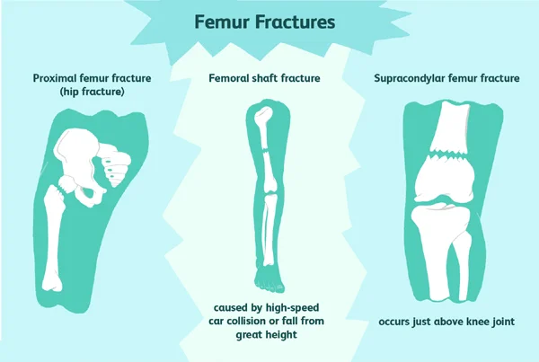 Fractures