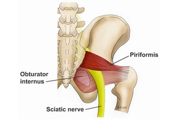 Piriformis Syndrome