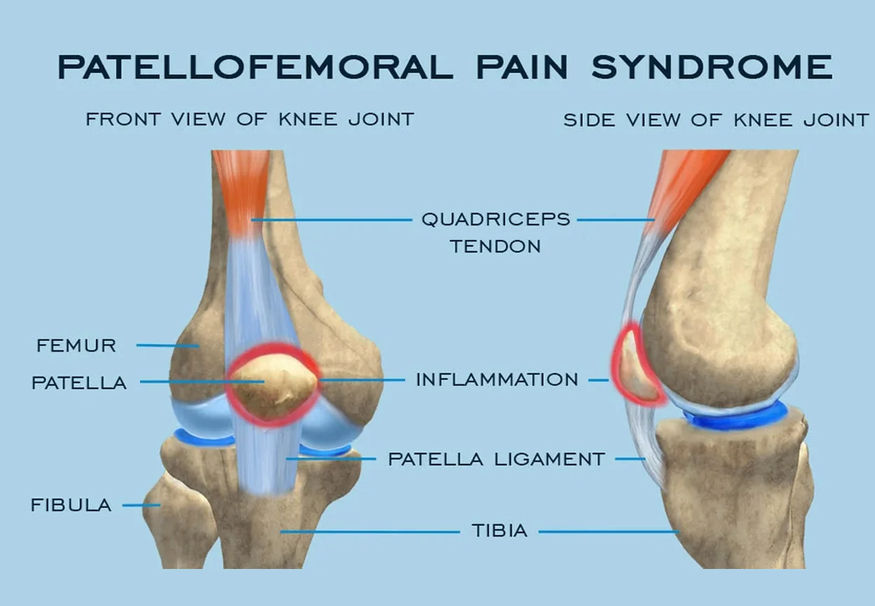Patellofemoral Pain Syndrome