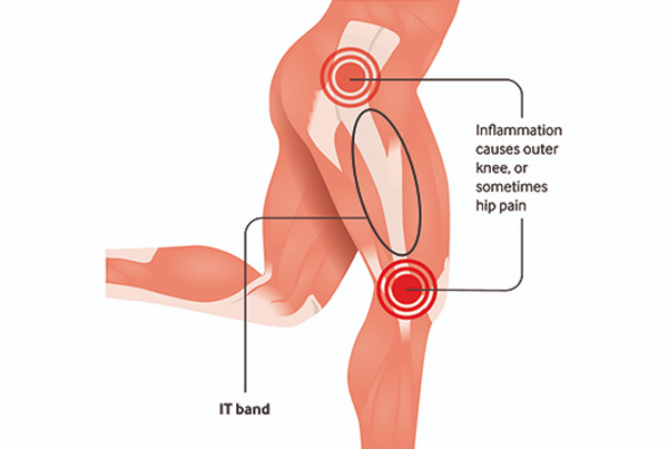 Iliotibial Band Syndrome