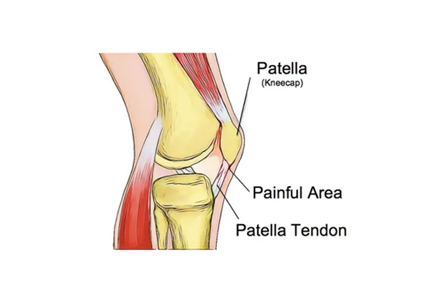 Patella Tendonitis