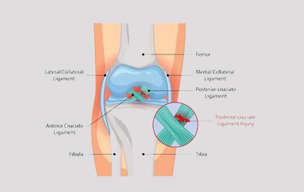PCL Injuries