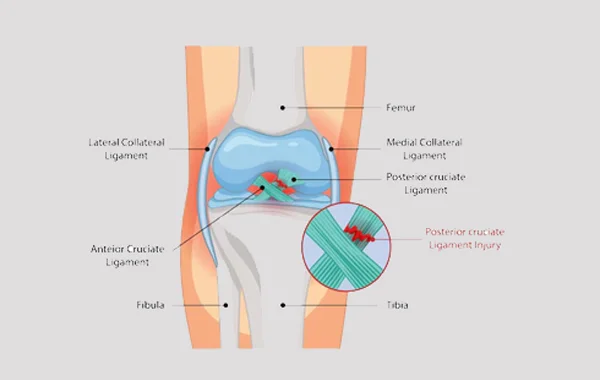 PCL Injuries