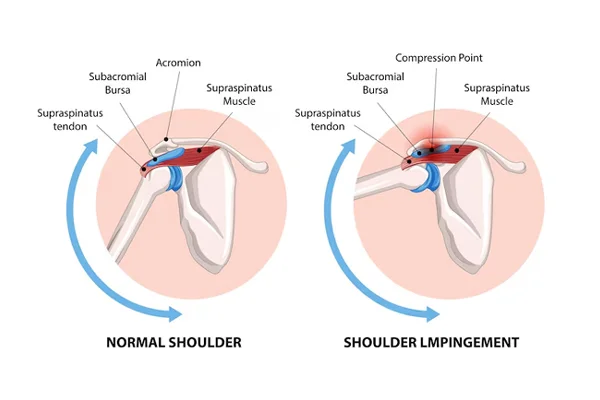 Supraspinatus Tear