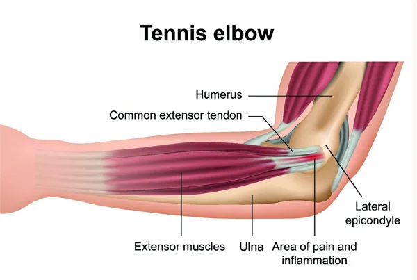 Tennis Elbow