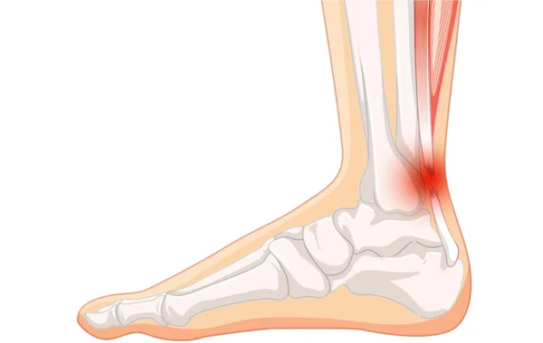 Ankle Ligament Injuries