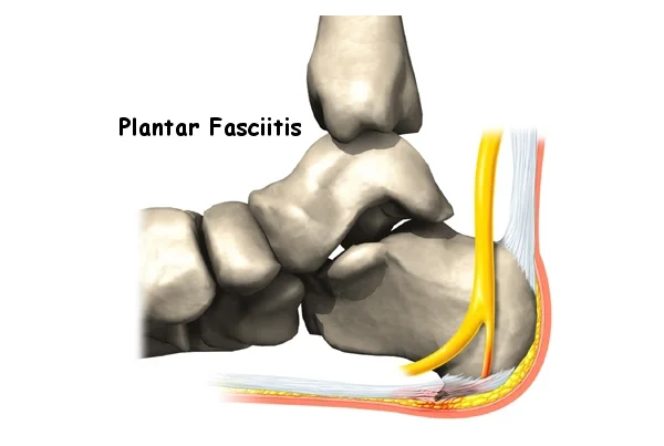 Plantar Fasciitis